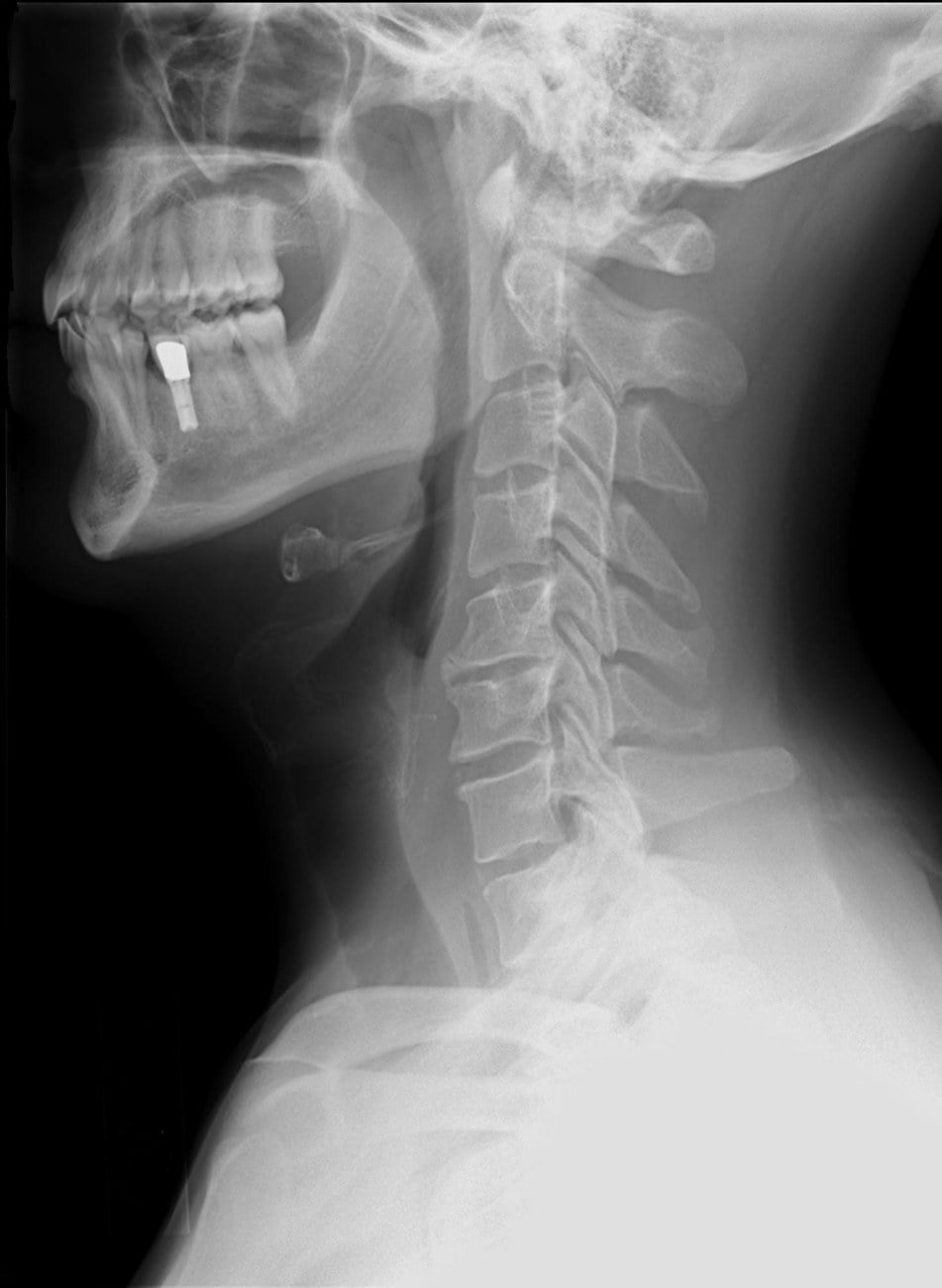 Lateral cervical-spine radiograph — the view on which atlantoaxial subluxation and the Ranawat measurement of superior odontoid migration are assessed.