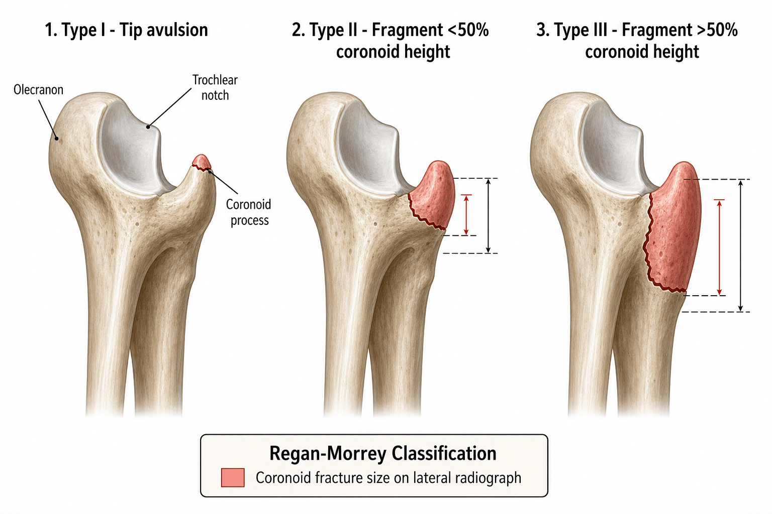 Regan-Morrey classification of coronoid fractures: type I tip, type II up to 50%, type III over 50%