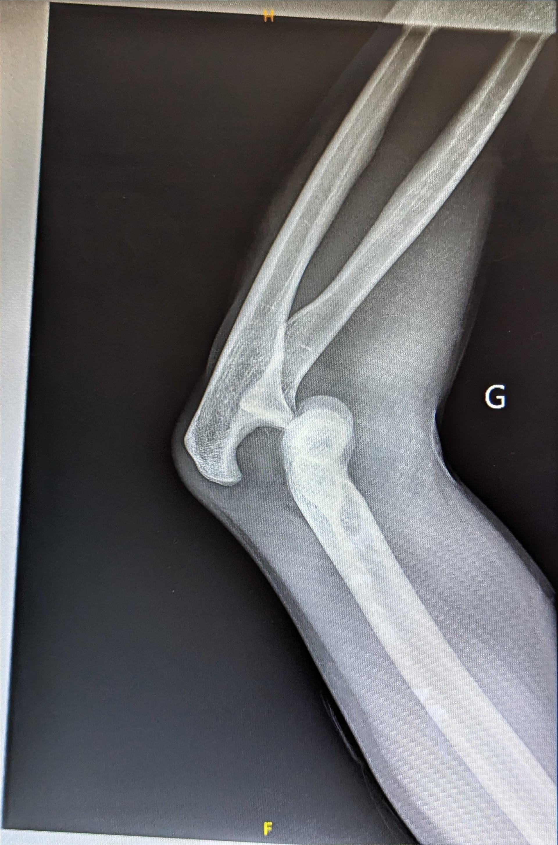 Lateral radiograph of a posterior elbow dislocation with the ulna and radius displaced behind the distal humerus