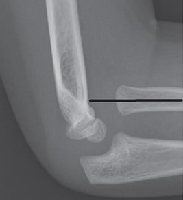 Lateral elbow radiograph with the radiocapitellar line drawn not passing through the capitellum