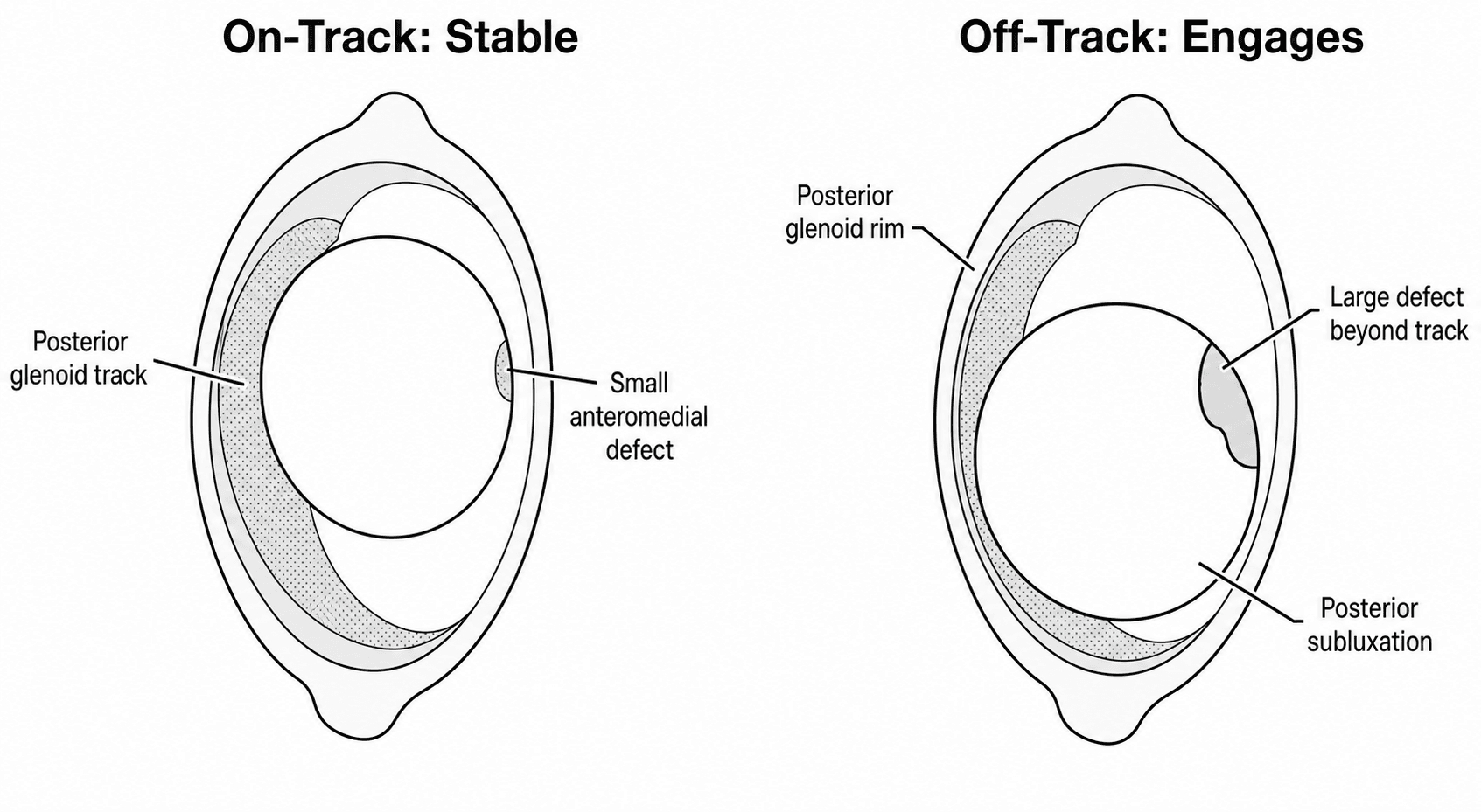 On-track versus off-track reverse Hill-Sachs lesion, glenoid track concept