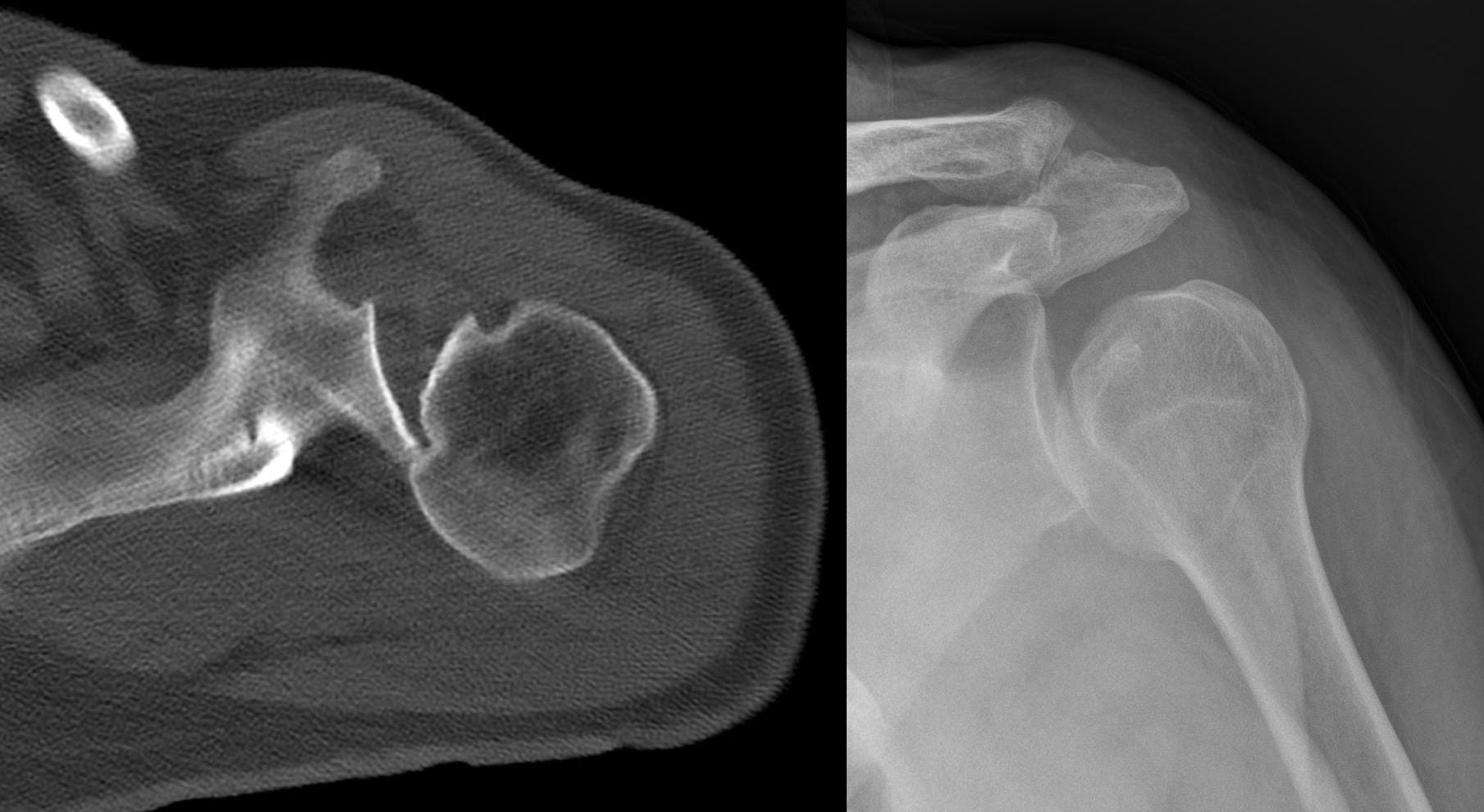 Axial CT and AP radiograph of a posterior shoulder dislocation showing an anteromedial humeral head impaction defect, the reverse Hill-Sachs lesion.