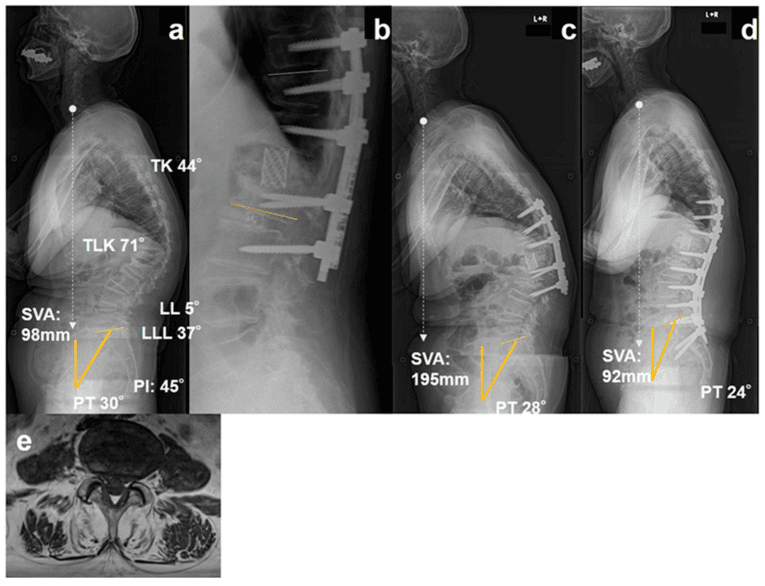 Serial standing lateral radiographs and an axial MRI slice showing distal junctional collapse after short fixation and later longer instrumentation