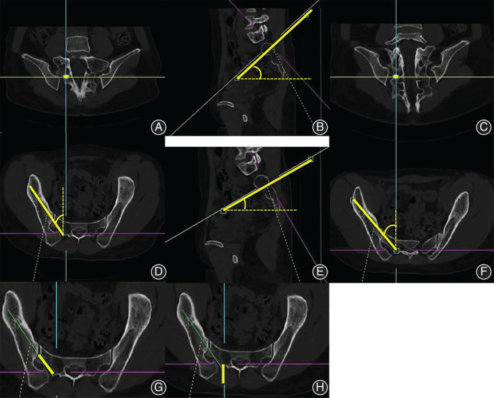 Pelvic CT reconstructions in coronal, sagittal and axial planes planning two S2 alar iliac screw trajectories