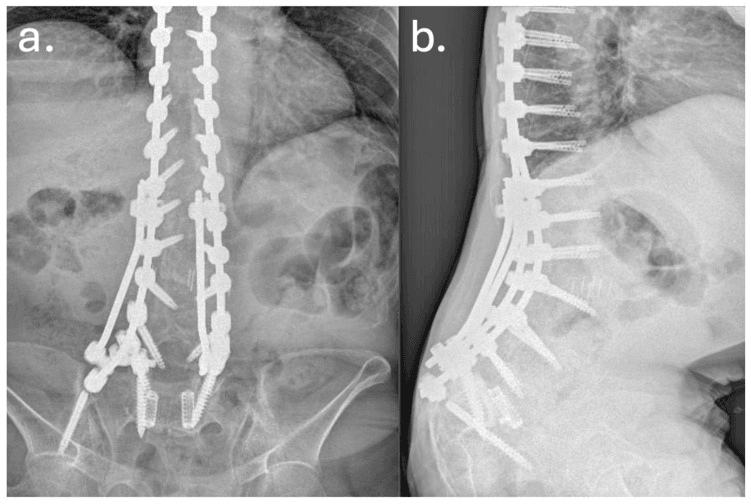AP and lateral radiographs of a long construct ending in bilateral iliac screws, with lucency around both iliac screws