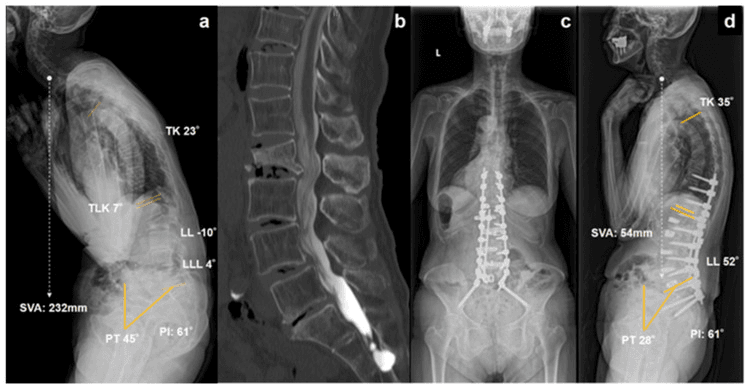 Standing lateral radiograph, sagittal CT and postoperative standing radiographs of osteoporotic kyphosis treated with long fixation to the pelvis