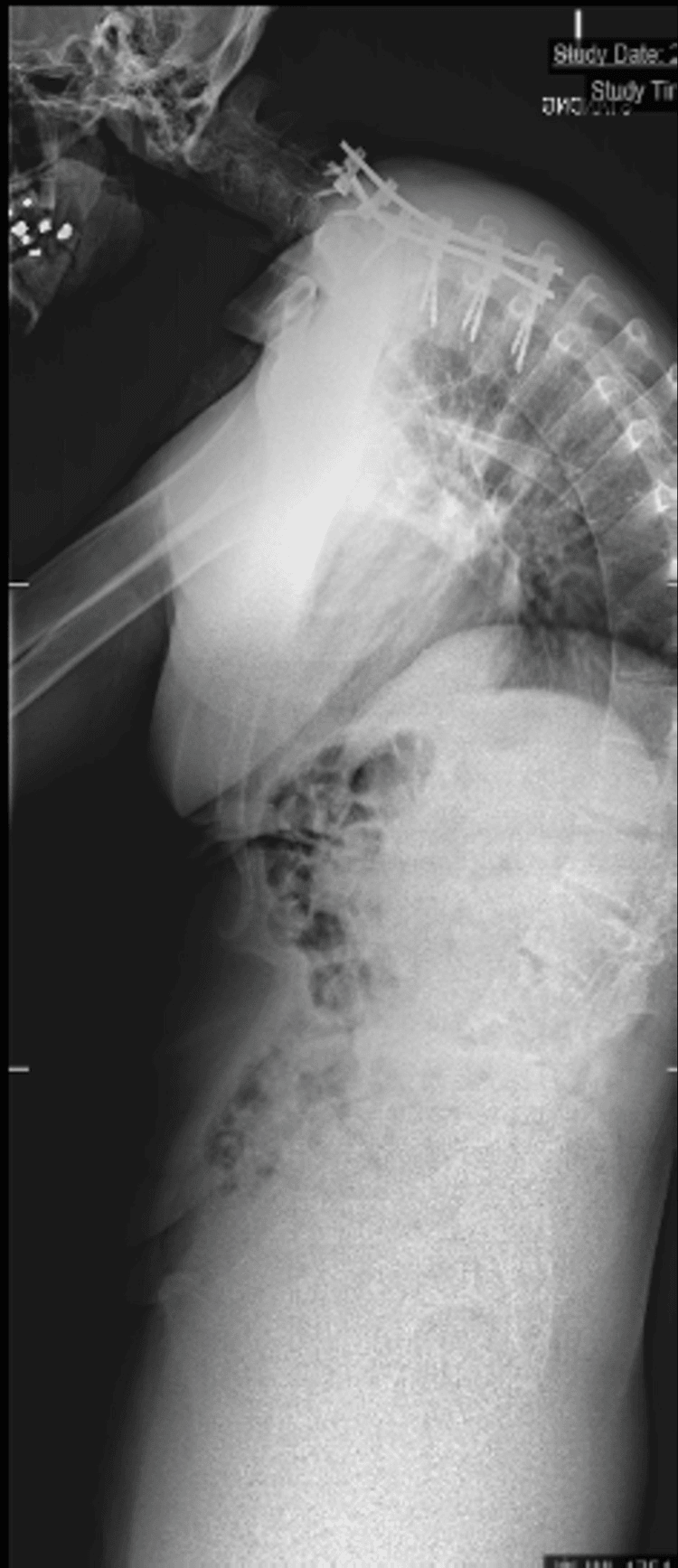 Standing lateral radiograph after T1 pedicle subtraction osteotomy with posterior instrumentation across the cervicothoracic junction
