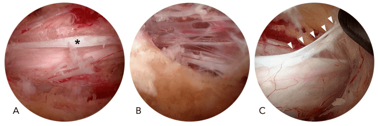 Three endoscopic views of a dural fold, an epidural adhesion and a meningovertebral ligament