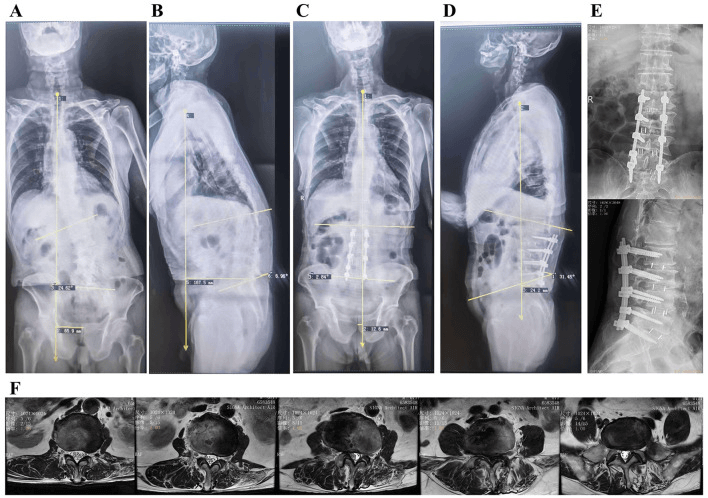 Standing AP and lateral full-spine radiographs before and after surgery, postoperative lumbar radiographs and a row of axial lumbar MRI slices