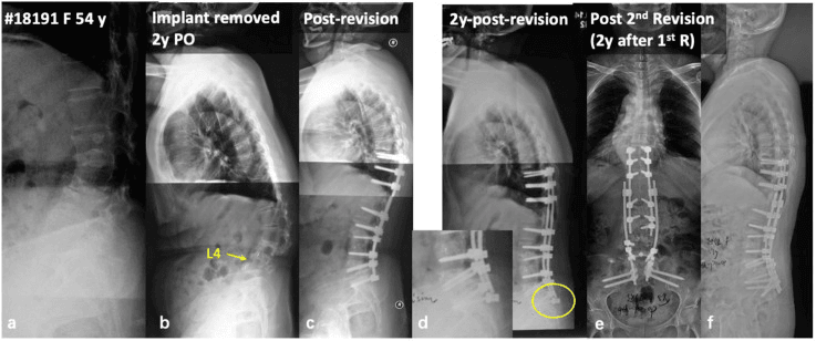 Serial radiographs of a 54-year-old woman through implant removal, revision and a second revision
