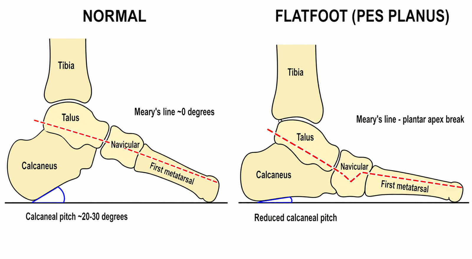 Lateral hindfoot schematic comparing Meary's line and calcaneal pitch in a normal foot versus flatfoot