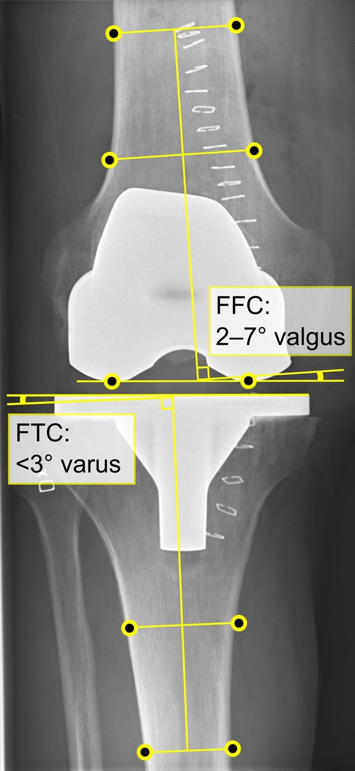 AP radiograph of a total knee replacement with the femoral and tibial component alignment angles annotated.