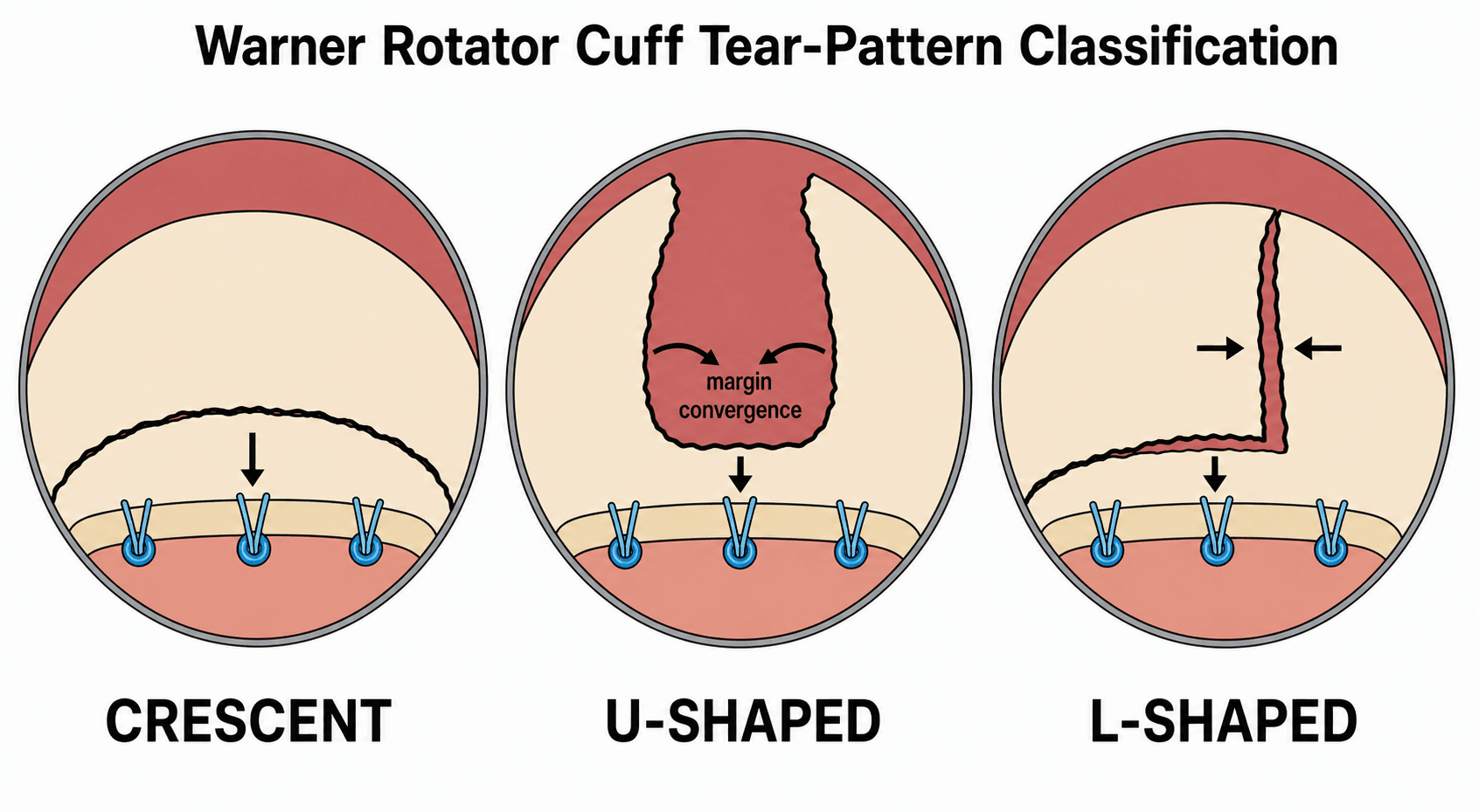 Schematic arthroscopic view of the three Warner rotator cuff tear patterns: crescent, U-shaped, and L-shaped, each showing the tendon-muscle tear margin relative to the greater tuberosity footprint and suture anchors.