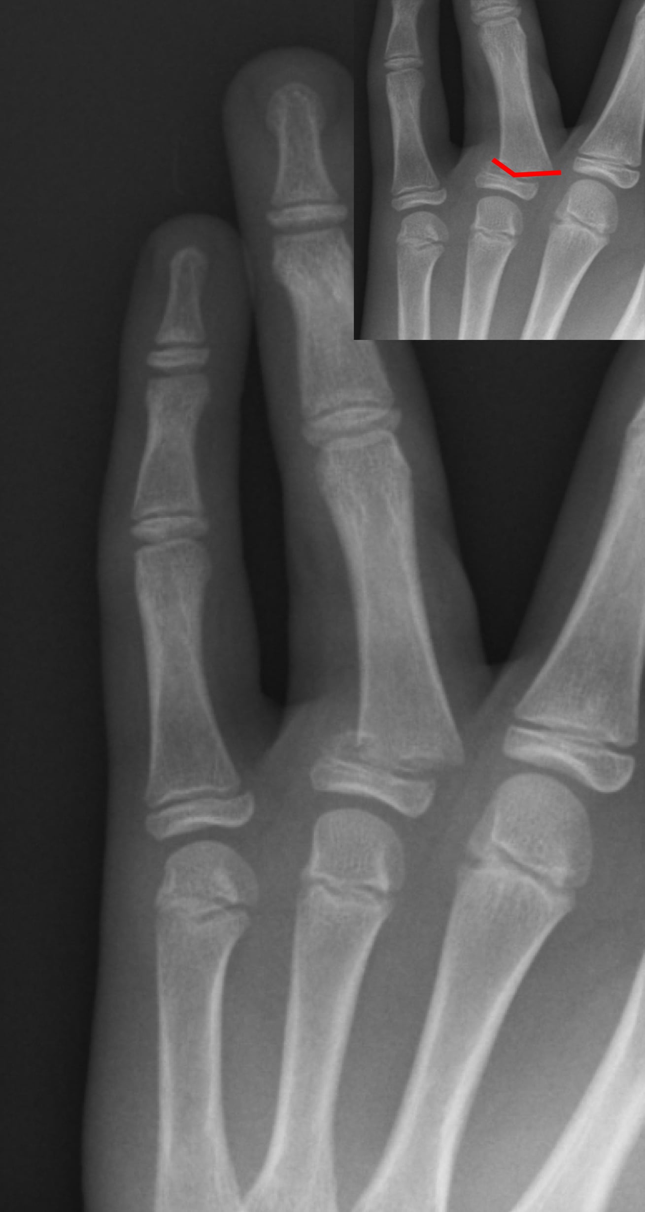 Hand radiograph of a child with a Salter-Harris II fracture of a proximal phalanx, magnified in an inset