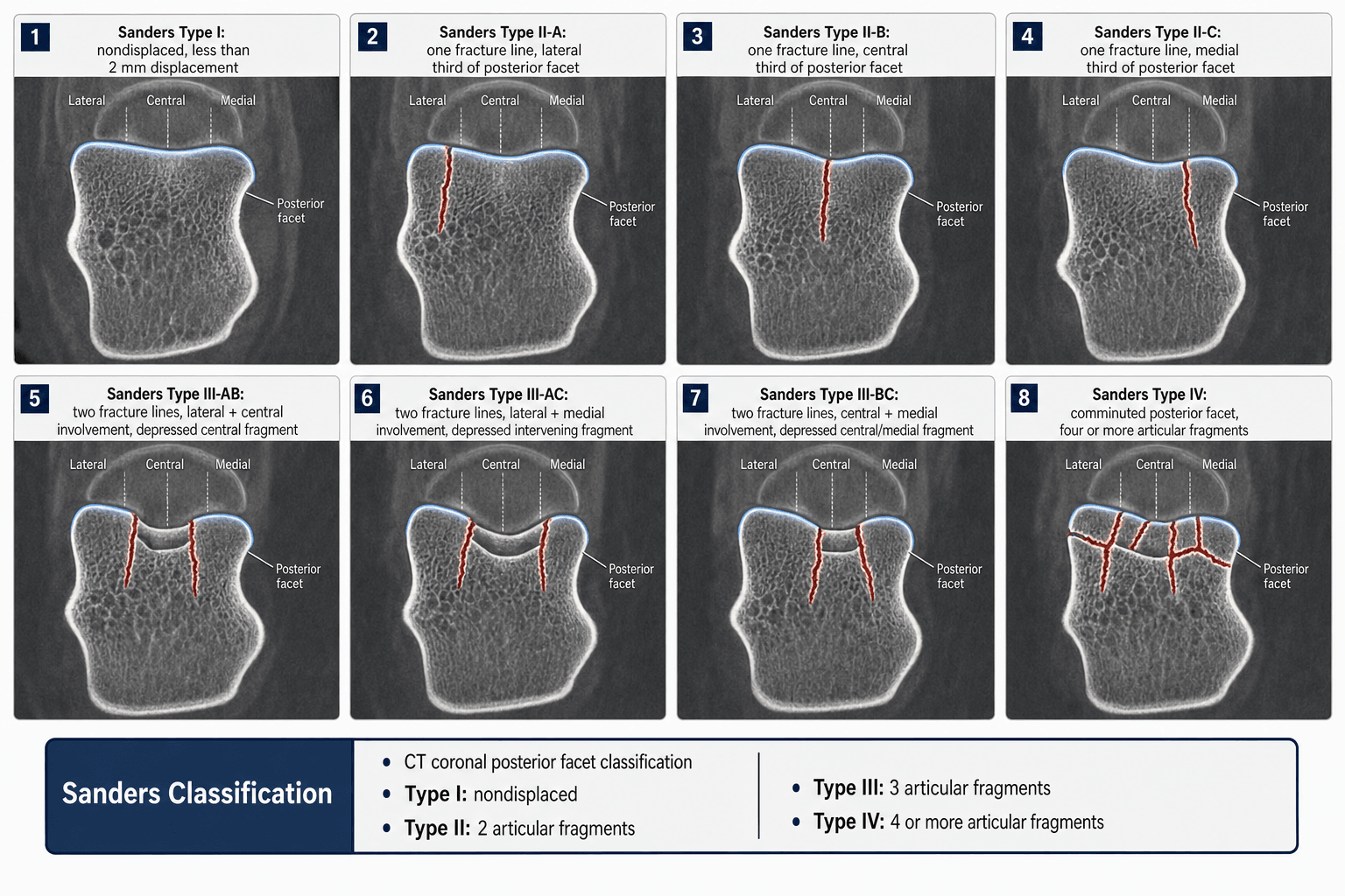 Sanders classification of calcaneal fractures on coronal posterior-facet CT: types I, IIA-C, IIIAB/AC/BC and IV with lateral/central/medial reference lines