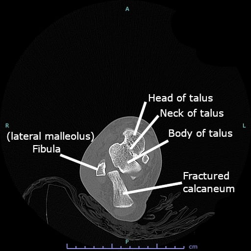 Axial CT through the hindfoot showing a fractured calcaneus, with the head, neck and body of the talus and the fibula (lateral malleolus) labelled for orientation.