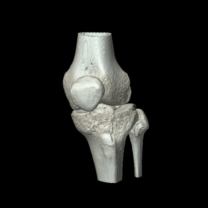 Three-dimensional CT reconstruction of a comminuted proximal tibial plateau fracture.