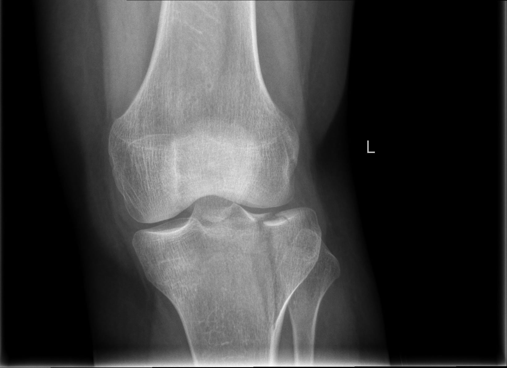 AP radiograph of the left knee showing a lateral tibial plateau fracture with articular depression.