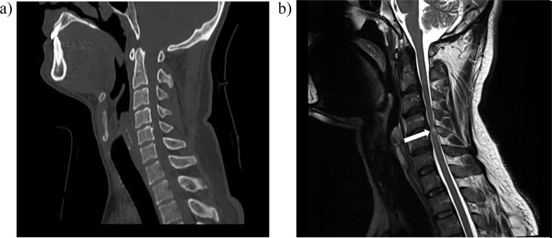 Paired sagittal cervical CT (a) and MRI (b) in SCIWORA: CT shows no fracture while the MRI arrow marks an intramedullary cord contusion.