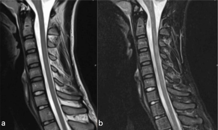 Sagittal T2 (a) and STIR (b) cervical MRI with normal cord signal in a paediatric SCIWORA case.