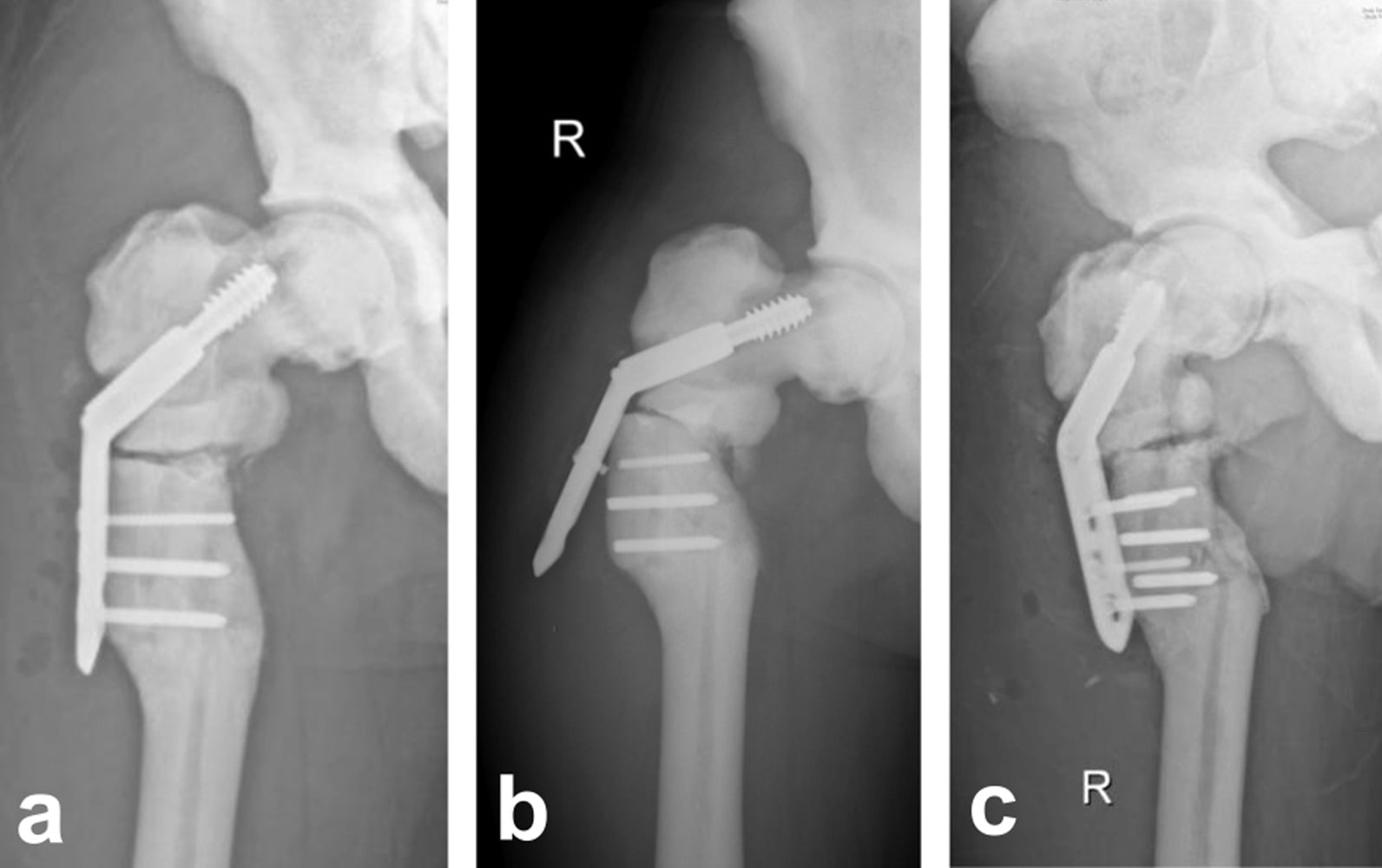 Radiographs of proximal femur fracture fixation failure and DHS revision in osteopetrosis