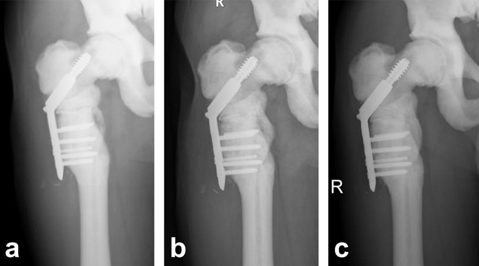 Radiographs of revision fixation achieving solid fracture union in osteopetrosis