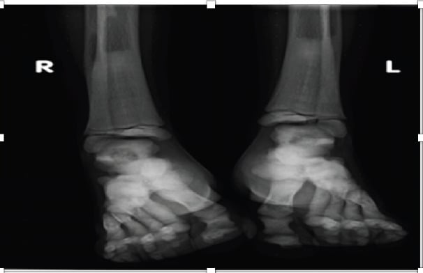 AP radiographs of feet and ankles demonstrating osteopoikilosis spotted bone lesions