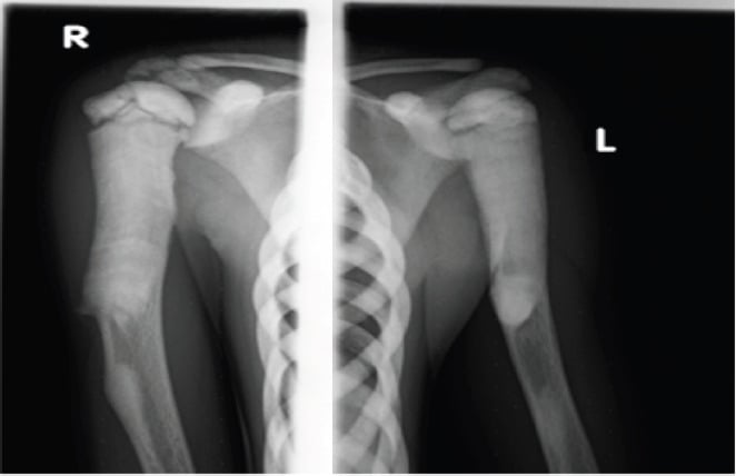 Bilateral humerus radiographs demonstrating osteopetrosis marble bone density