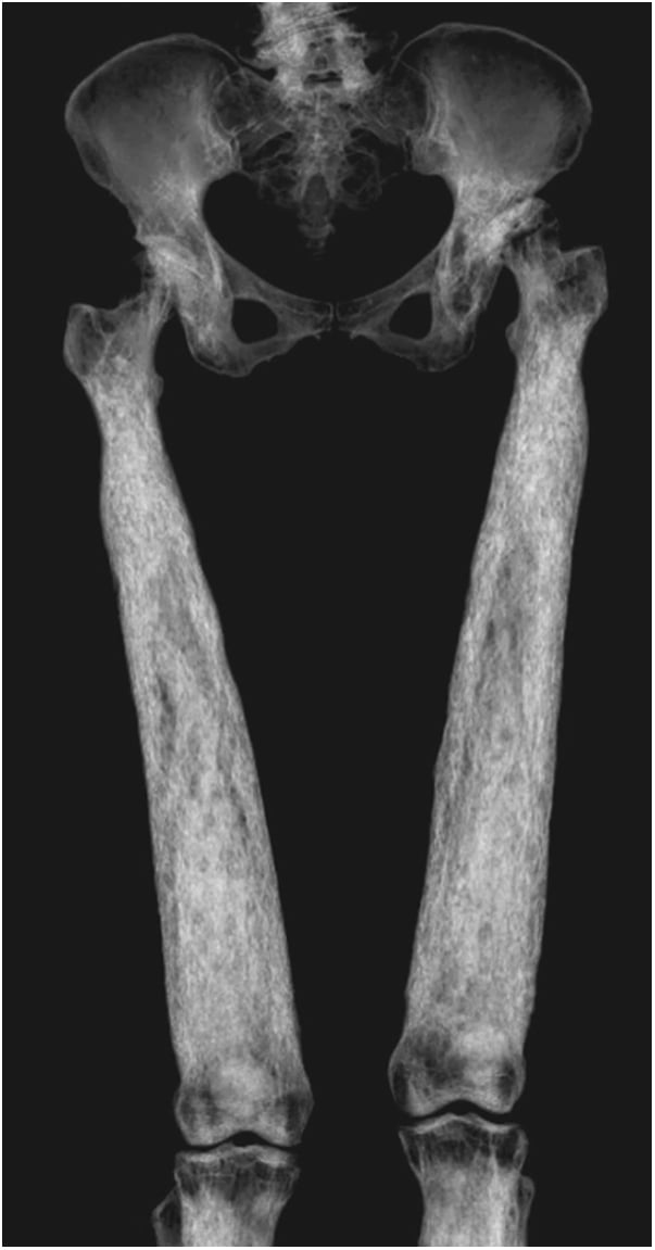 3D CT volume rendering of Camurati-Engelmann disease diaphyseal hyperostosis