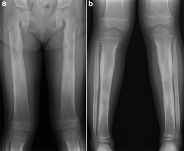 AP radiographs of femora and tibiae showing Camurati-Engelmann disease cortical thickening