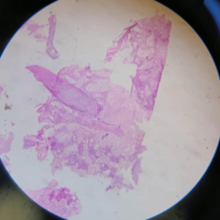 High-power haematoxylin and eosin section showing mature cortical bone with chronic inflammatory change.