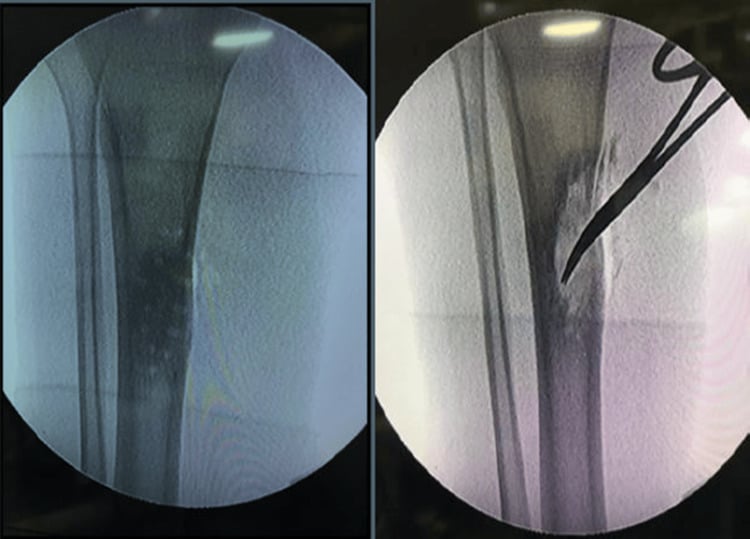 Intraoperative fluoroscopic views during tibial corticotomy, debridement and saucerisation.