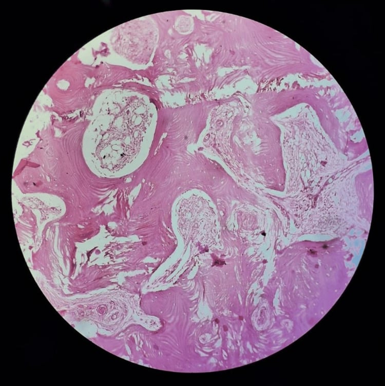Histological section showing bony trabeculae within dense fibrous and fibrovascular tissue with chronic inflammatory cells.