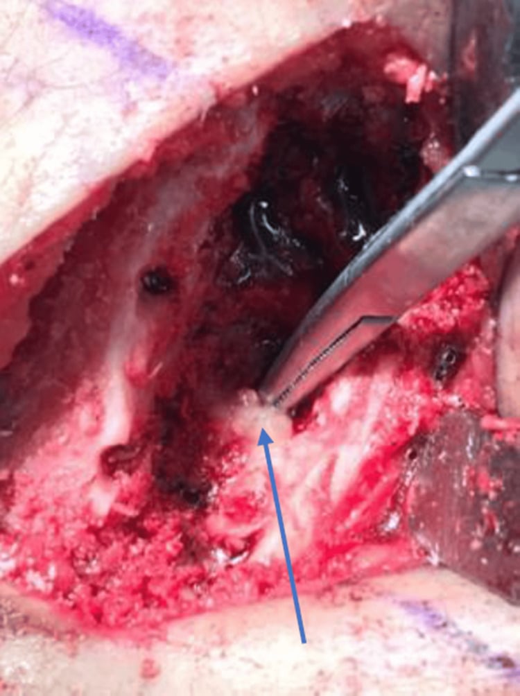 Tightly framed intraoperative photograph of dense sclerotic tibial bone during debridement.