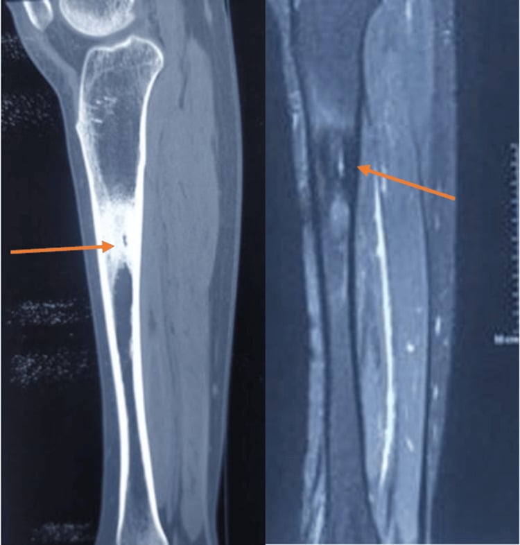 Sagittal T1- and T2-weighted MRI showing tibial periosteal thickening and a focal cortical defect.