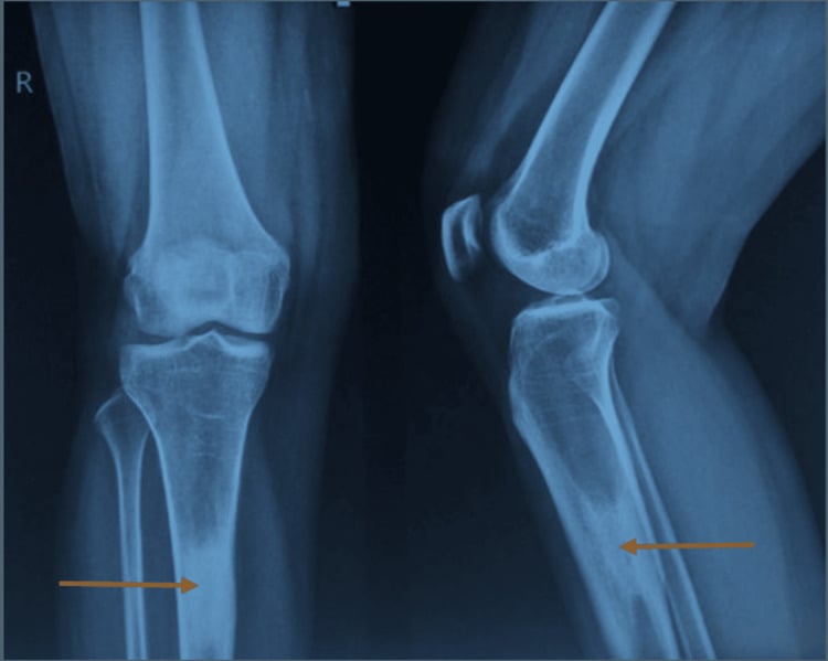 AP and lateral radiographs showing an ill-defined sclerotic proximal tibial lesion with a small rounded lucency.