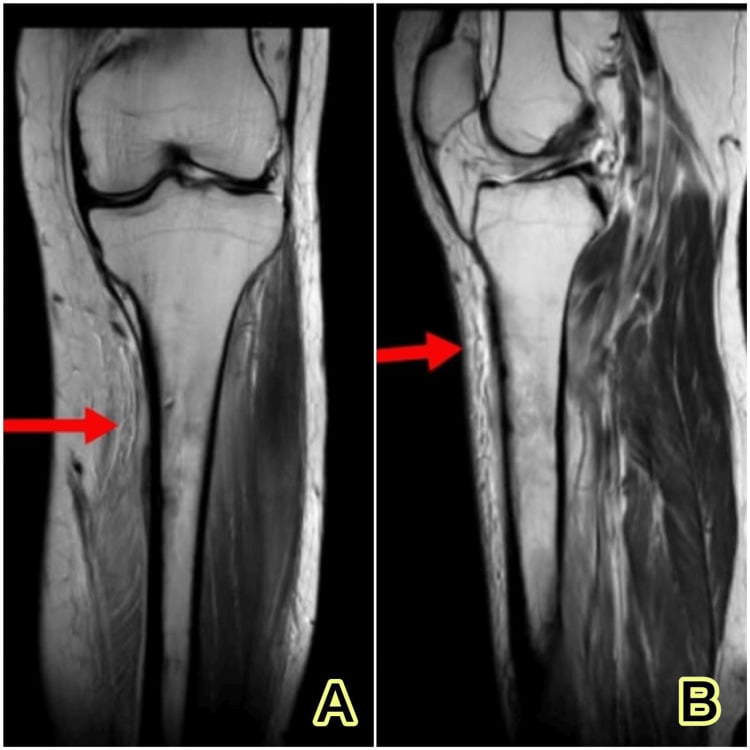 MRI of the proximal tibia showing subperiosteal fluid and irregular medial cortical erosion in sclerosing osteomyelitis.