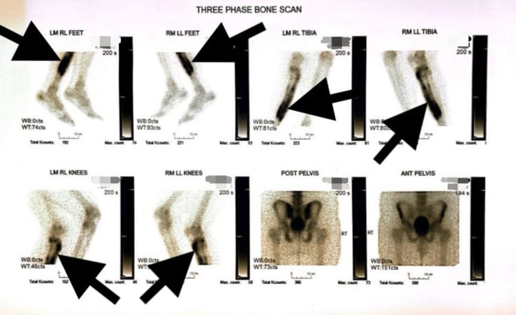 Three-phase bone scan showing increased tracer uptake in the symptomatic tibia and additional skeletal sites.
