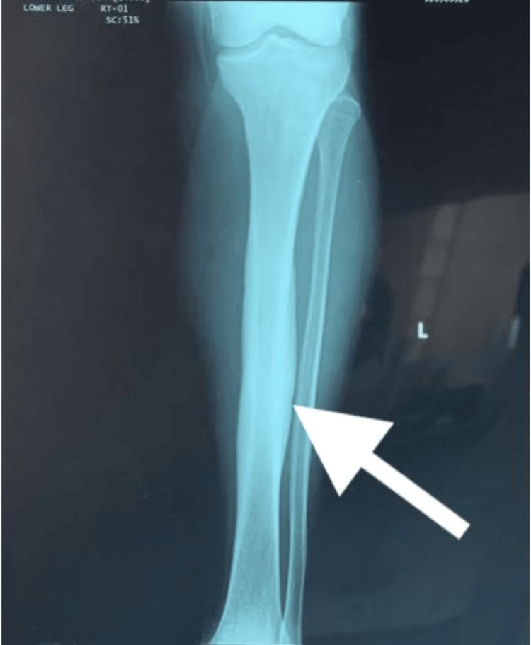 AP radiograph of the left tibia showing mid-diaphyseal cortical thickening in Garré sclerosing osteomyelitis.