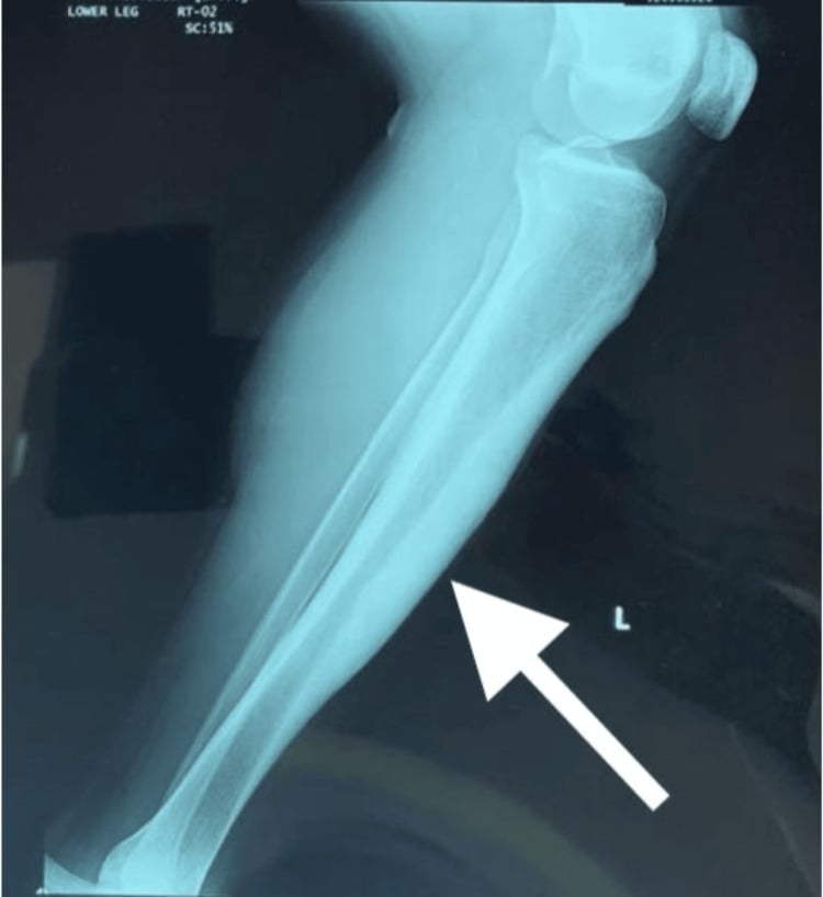 Lateral radiograph of the left tibia showing marked anterior cortical thickening in Garré sclerosing osteomyelitis.
