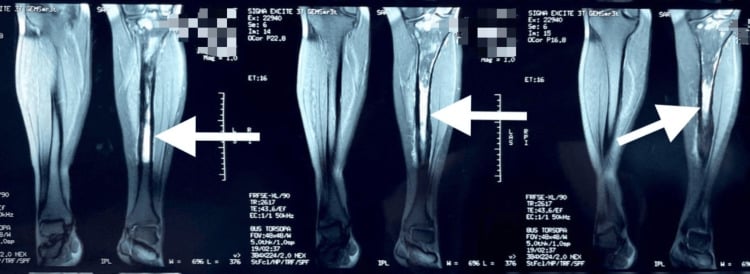 Multiplanar MRI of the tibia showing cortical thickening without a soft-tissue mass in Garré sclerosing osteomyelitis.