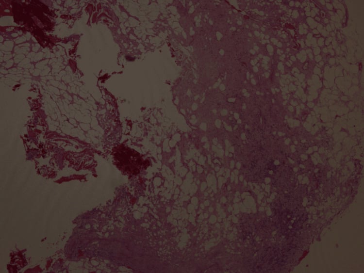 Histology from a tibial core biopsy showing an inflammatory reactive process with xanthogranulomatous change.