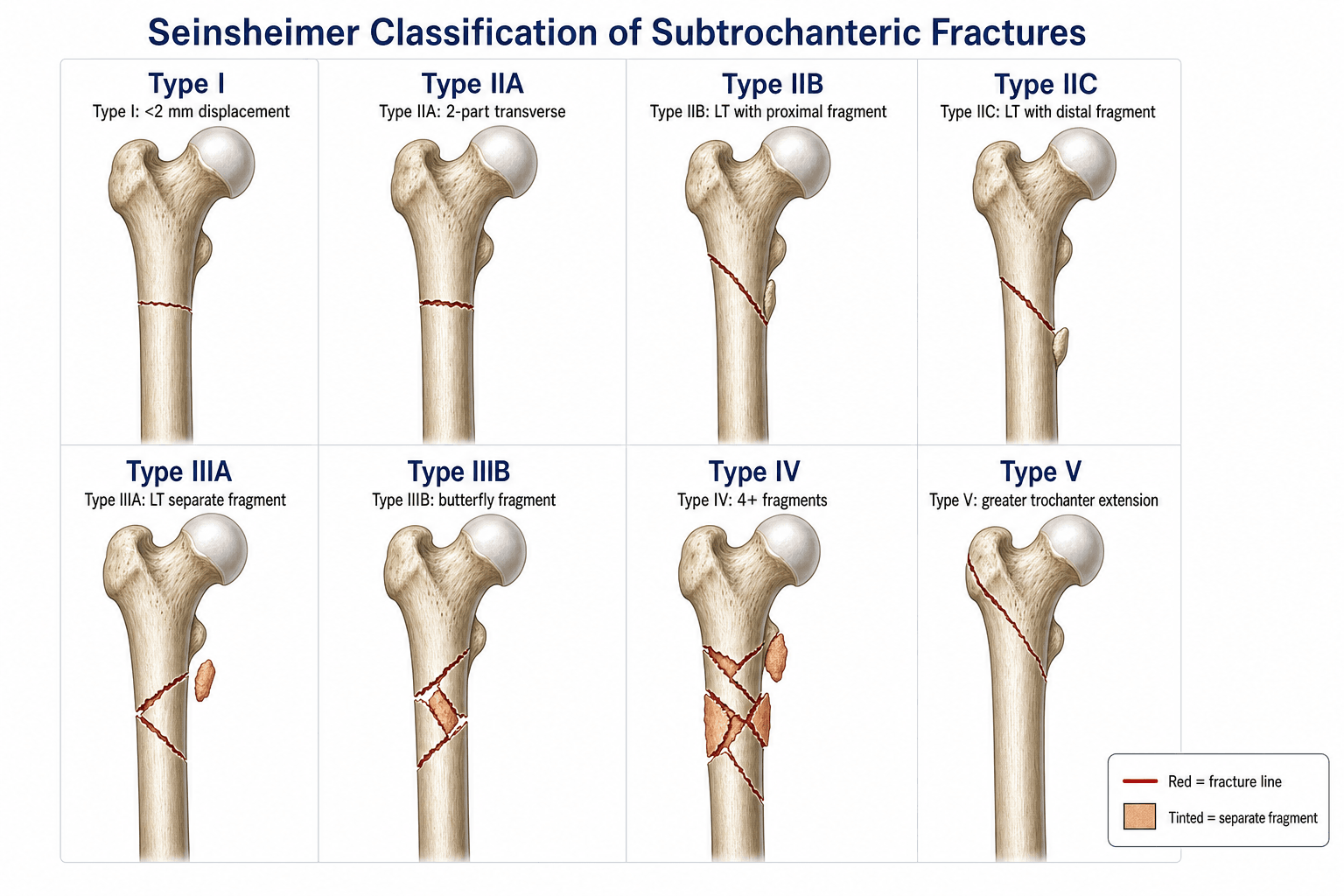 Seinsheimer Classification of Subtrochanteric Fractures, eight patterns across five types