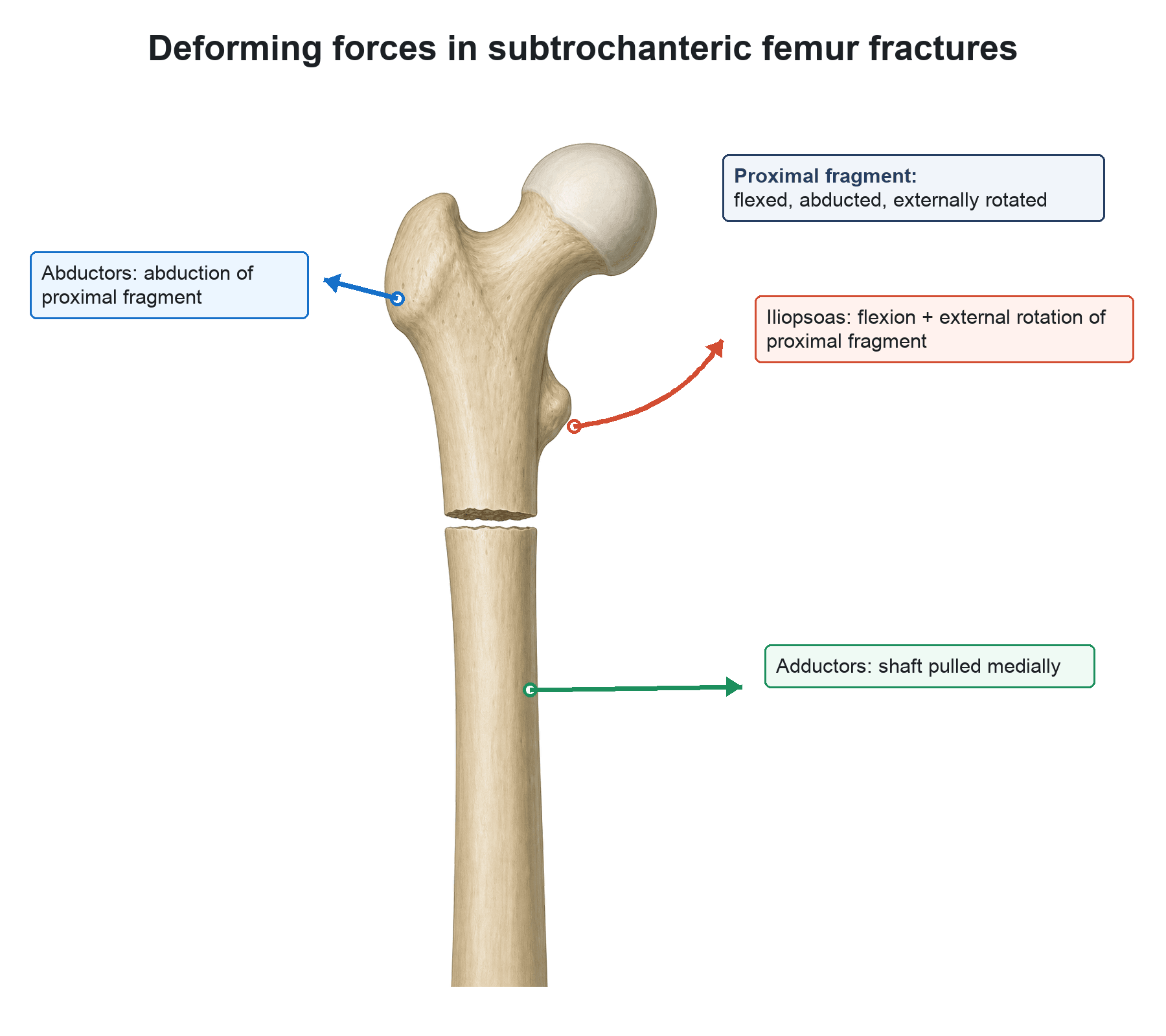 Diagram of the deforming muscle forces on a subtrochanteric femur fracture: iliopsoas, abductors and adductors acting on the proximal fragment and shaft.