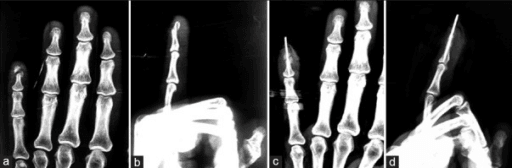 Distal phalangeal fracture imaging relevant to Seymour fracture assessment
