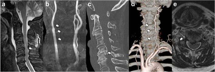 Sagittal T2-weighted fat-suppressed MRI showing cervical spinal cord hyperintensity and posterior element disruption
