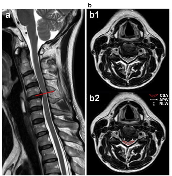 Sagittal and axial T2 MRI of the cervical spine demonstrating spinal cord compression and signal change