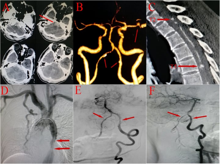 CT and CTA of the skull base and craniocervical junction illustrating spinal cord blood supply