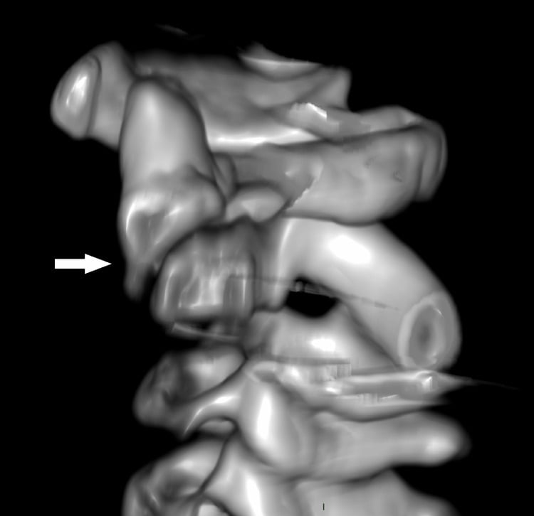 3D CT reconstruction showing a displaced cervical fracture-dislocation