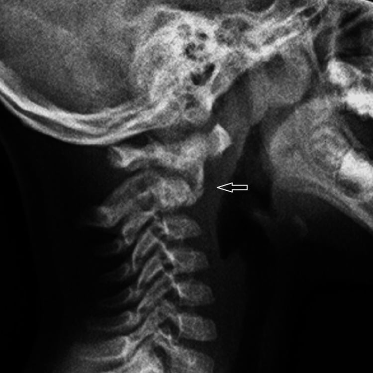 Lateral cervical spine radiograph showing an angulated upper cervical fracture-dislocation